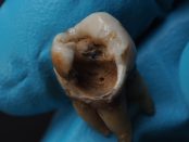 Treatments in Preventing Tooth Decay