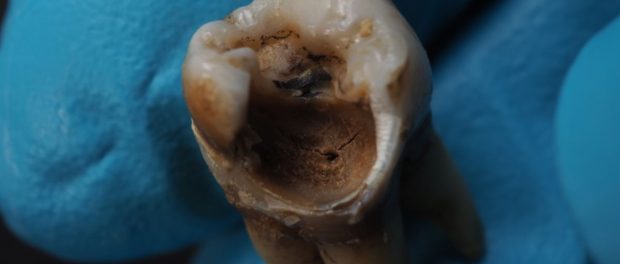 Treatments in Preventing Tooth Decay