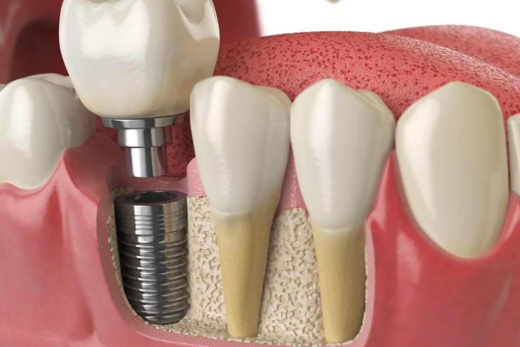 dental implants in Scottsdale 