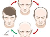 hair restoration