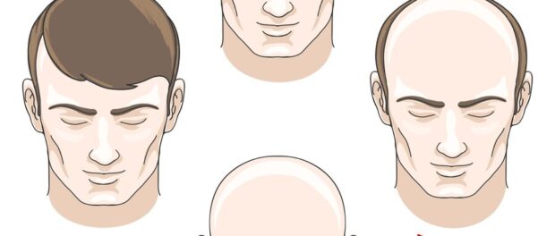 hair restoration