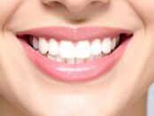teeth-whitening